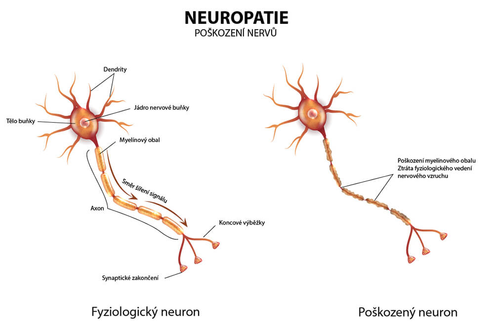 zdravy nerv vs poskodeny nerv